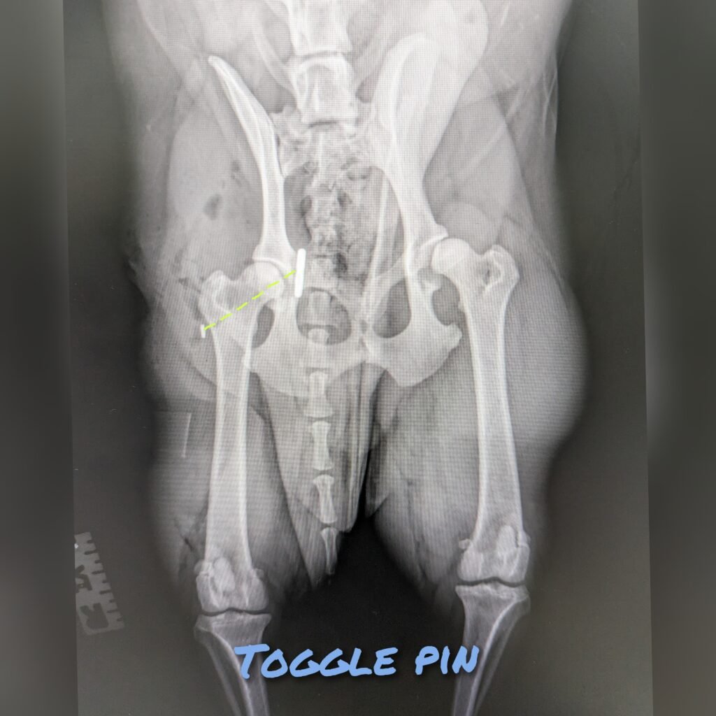 Hip Luxation – Toggle Pin technique gridart 20240215 161408955